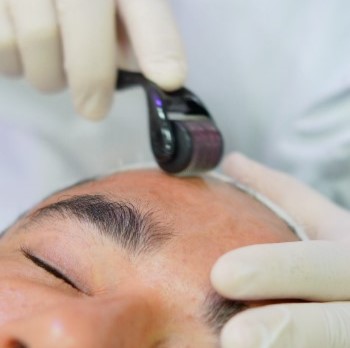 Microagulhamento Dermal