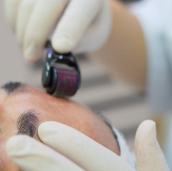 Microagulhamento Dermal - Image 3